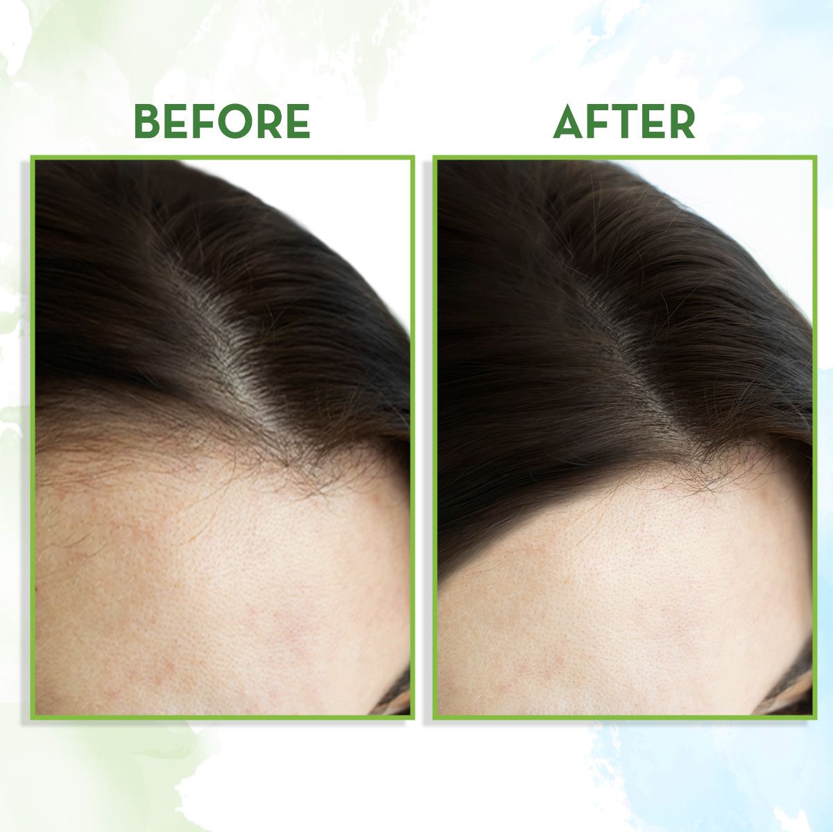 Share 124+ b12 deficiency hair loss reversible latest tnbvietnam.edu.vn