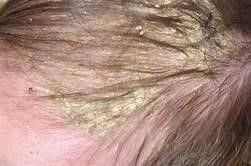Hair Oil nourishing the scalp.